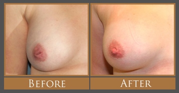 Areola Reduction Scars